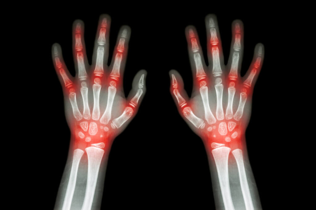 Newly discovered species of bacteria in the microbiome may be culprit behind rheumatoid arthritis