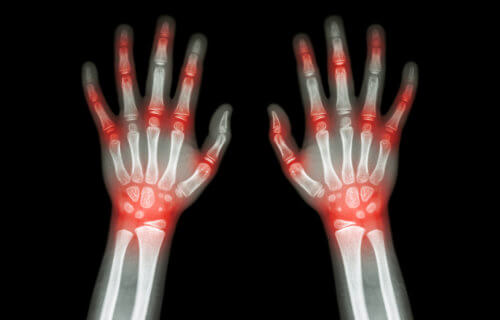 Rheumatoid arthritis x-ray