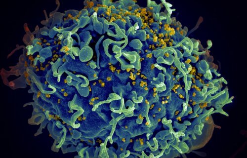 HIV, the AIDS virus (yellow), infecting a human cell